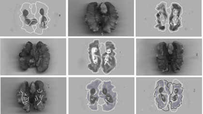 doubled up, still: Montage of walnut images. In one of the images you can see the foetuses pushing each other – during a scan we actually saw our twins kicking and pushing each other inside my belly.